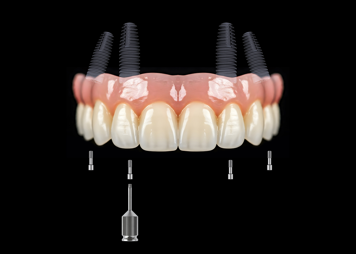 All-on-X implant care at Monroe Dental