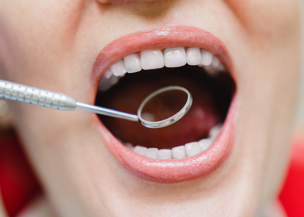 Cavitron dental cleaning overview