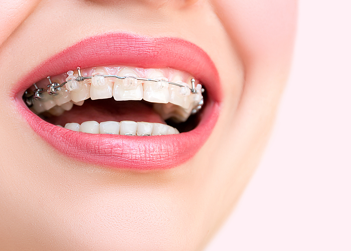 Candidates for clear aligner treatment
