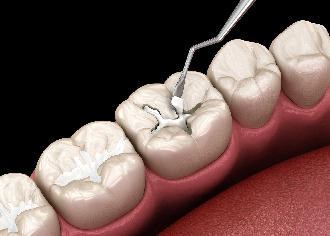 Tooth-colored composite filling
