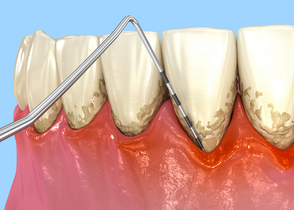 Aftercare following deep dental cleaning