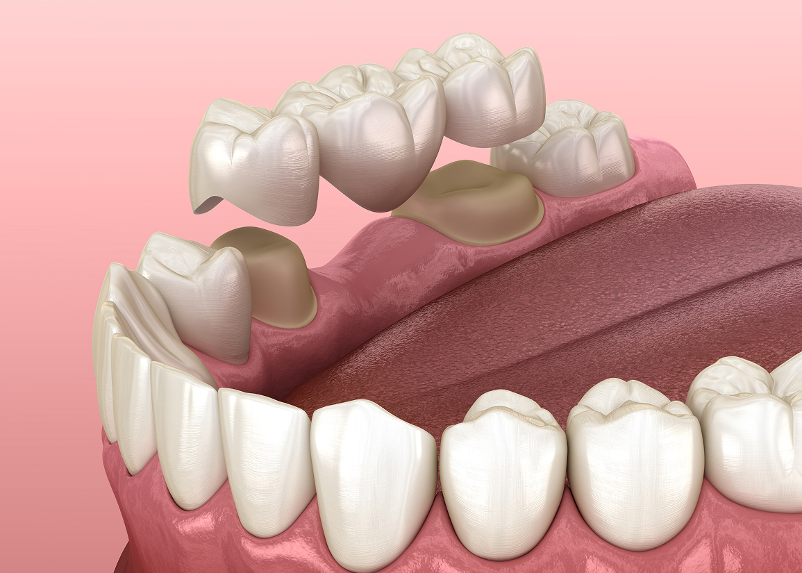 Dental bridge replacing missing teeth