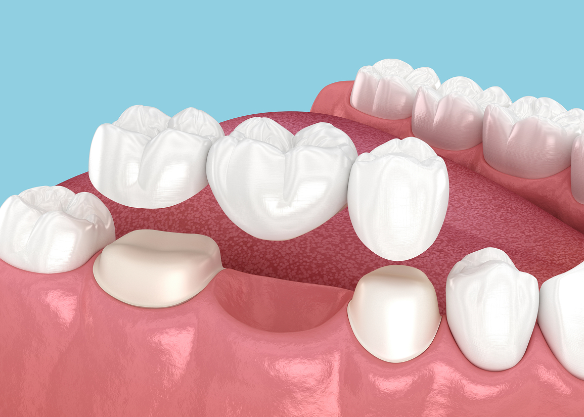 Dental bridge care and hygiene