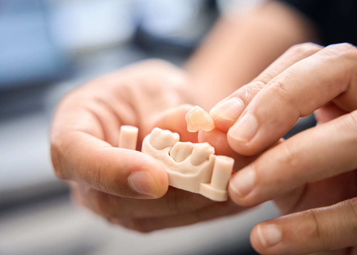 Dental crown treatment for damaged teeth