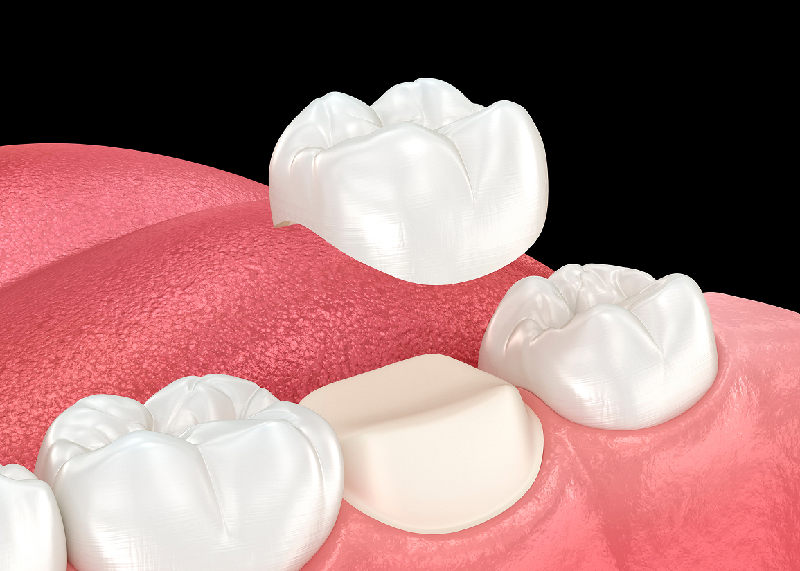 Dental crown care and maintenance