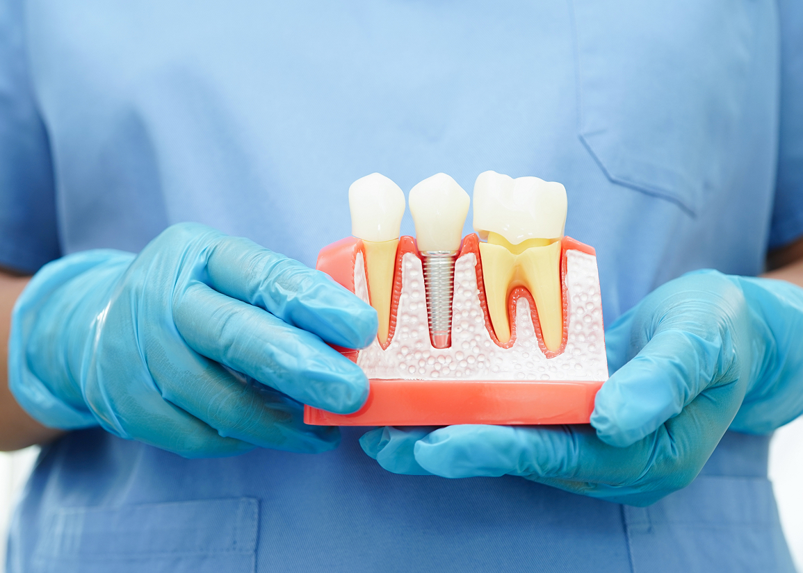 Candidates for implant consultation