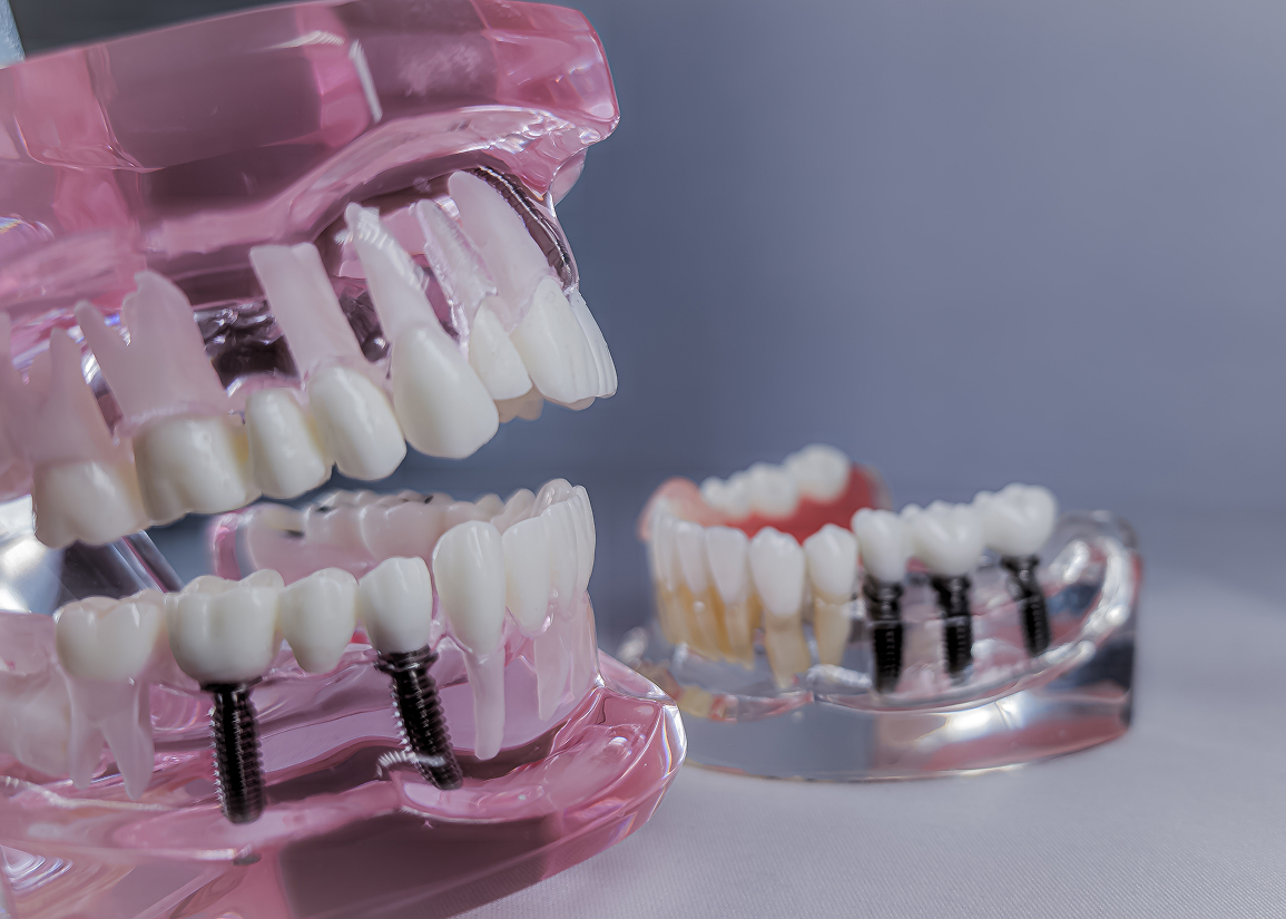 Dental implant restoration overview