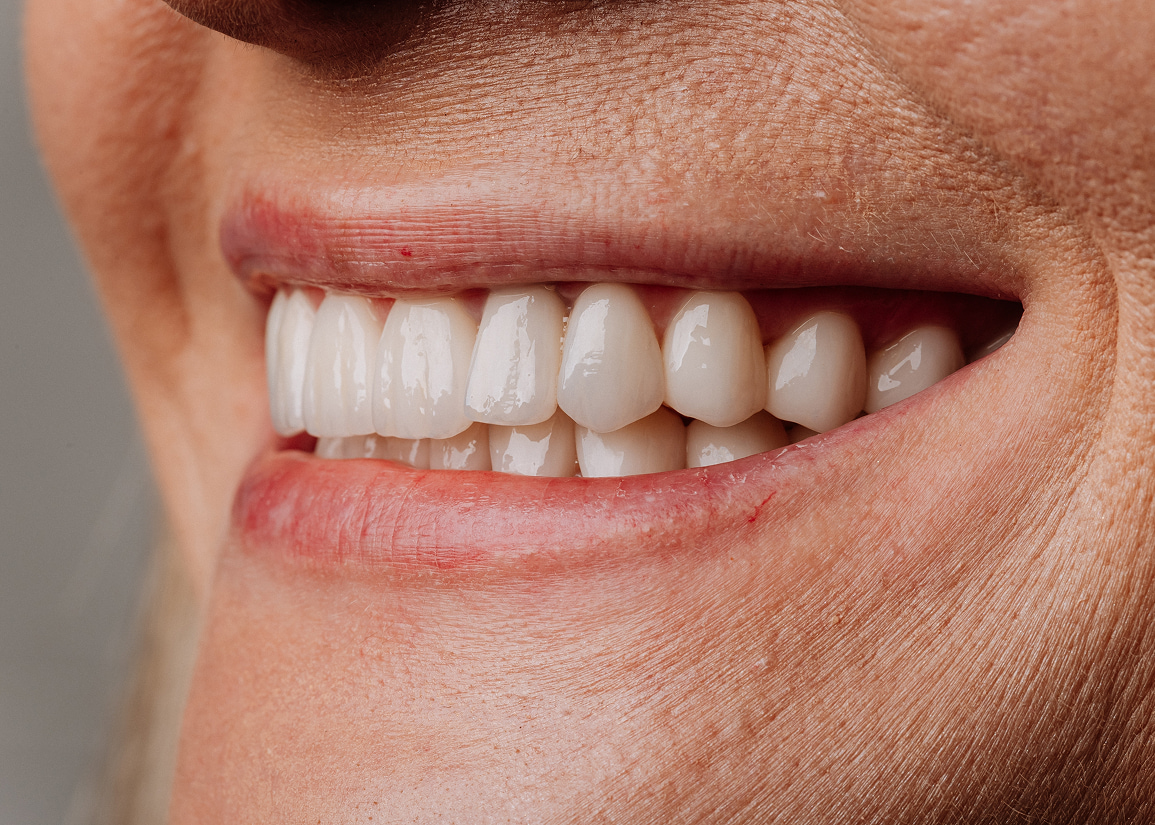 Candidates for implant restorations