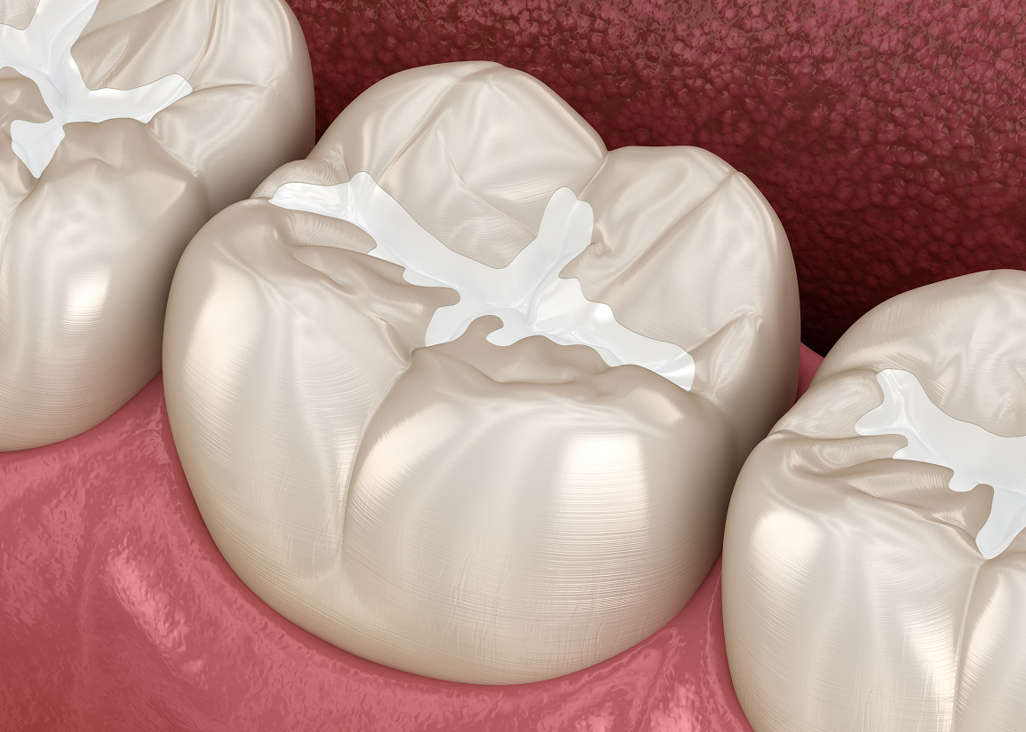 Dental sealants for cavity prevention