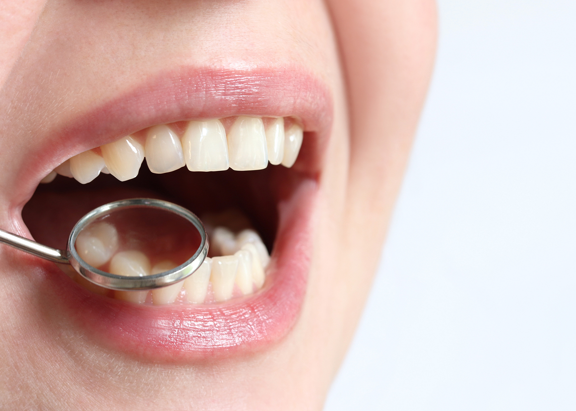 Dental sealants for children and adults