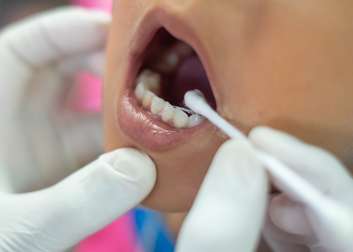 Professional fluoride dental treatment