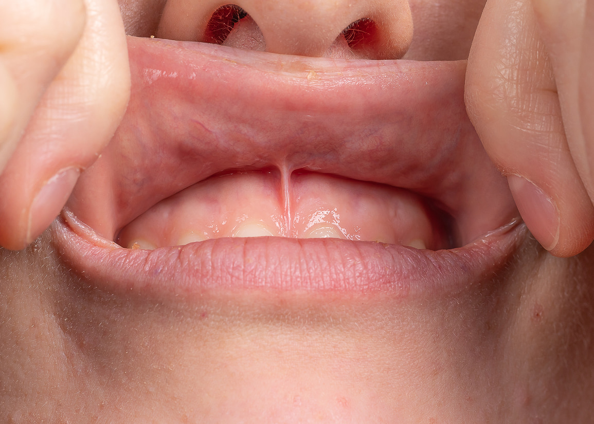 Labial or lingual frenectomy