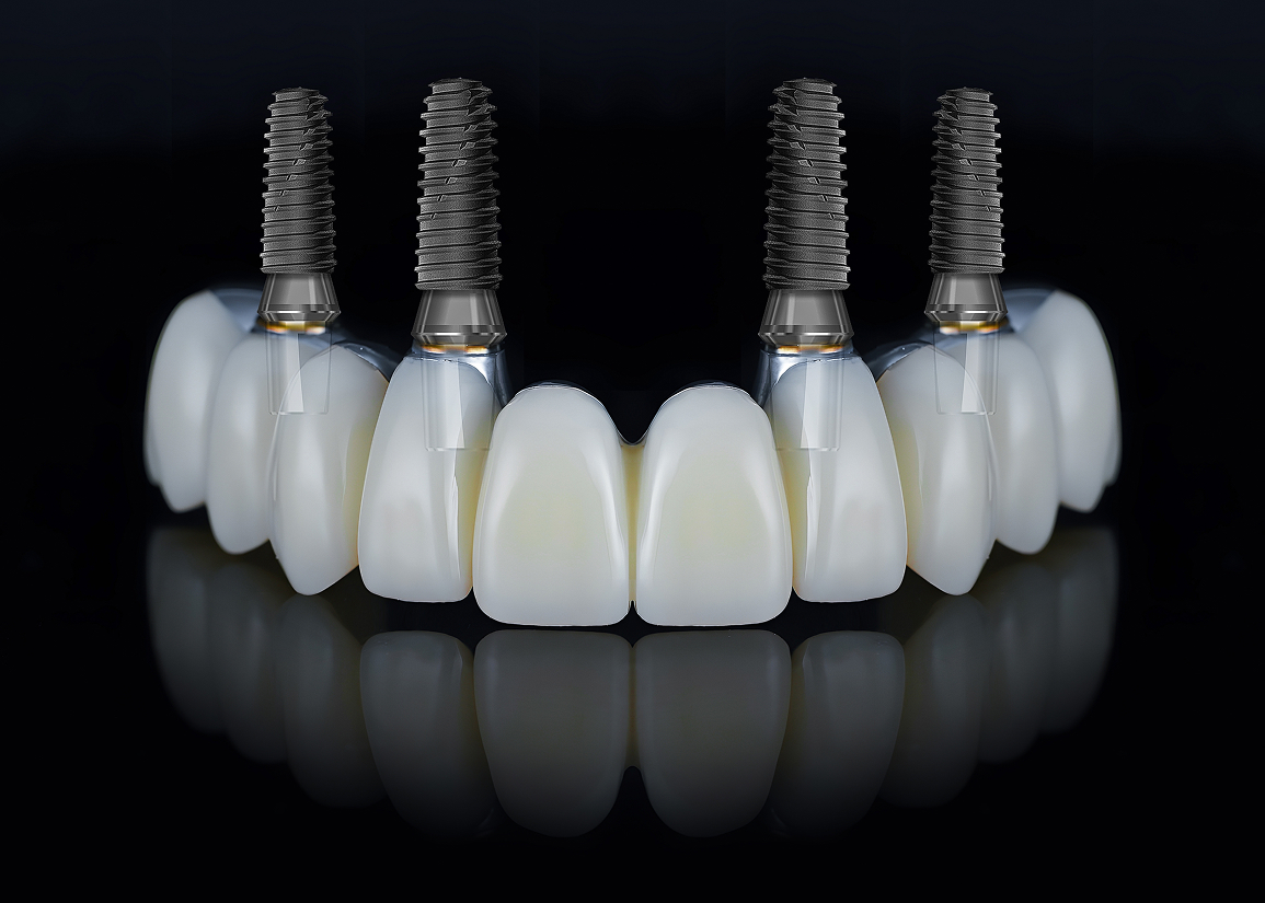 Full arch dental implants overview