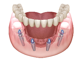 Permanent Zirconia Teeth Single Arch