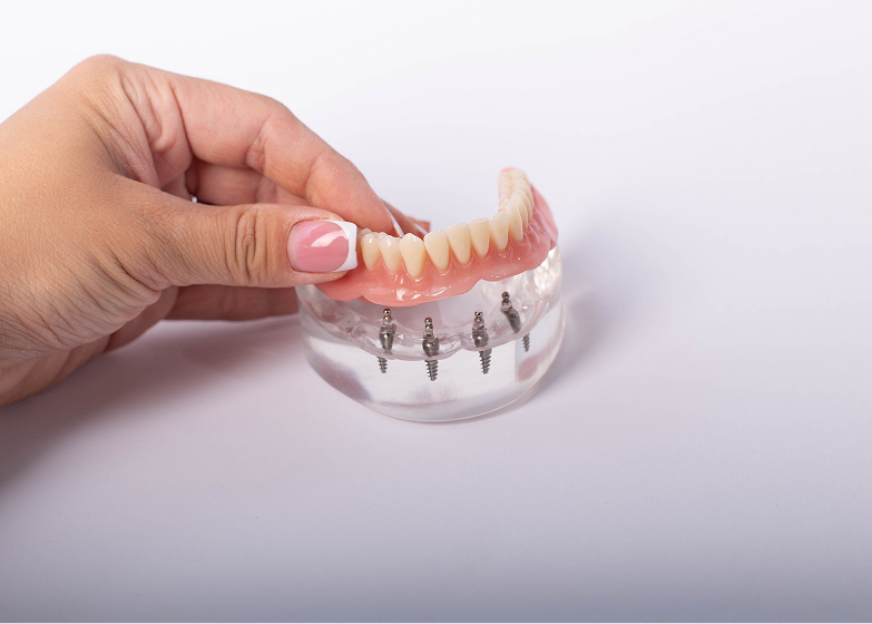 Removable Implant-Supported Dentures