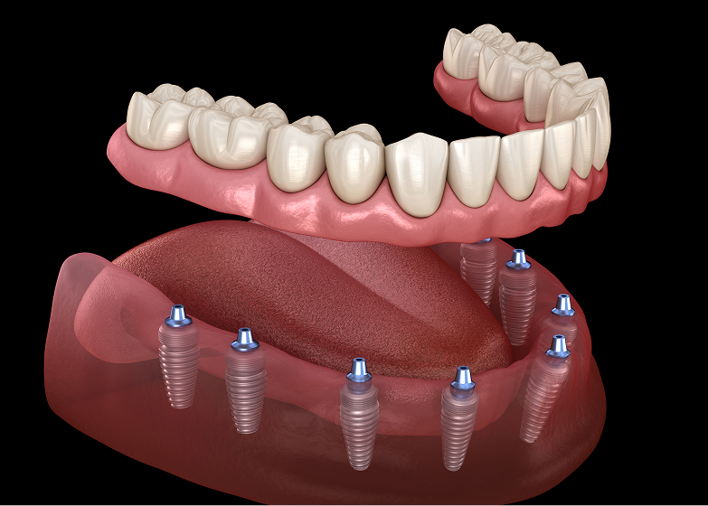 Fixed Implant-Supported Dentures