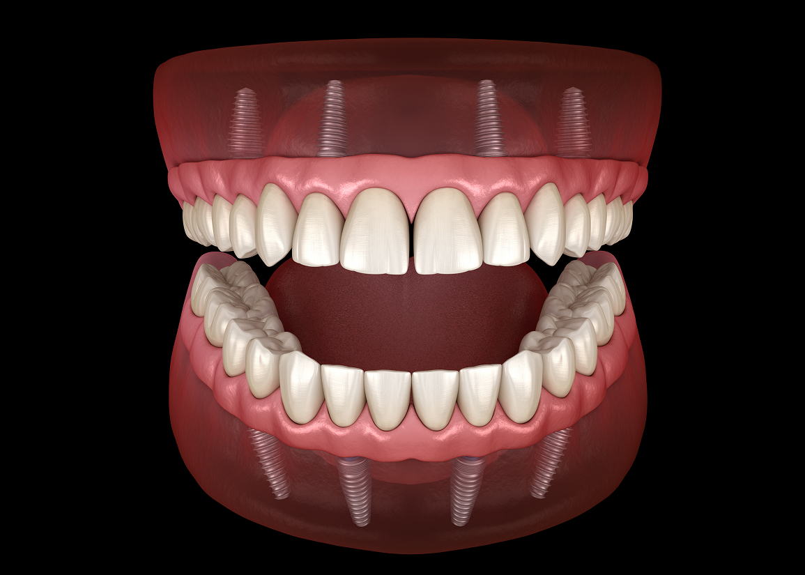 Difference between implant and traditional dentures