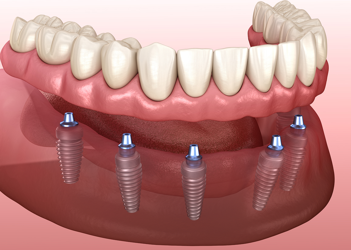 Implant-supported dentures at Monroe Dental