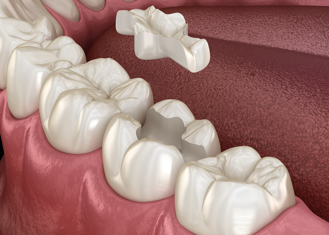 Inlays and onlays for tooth repair