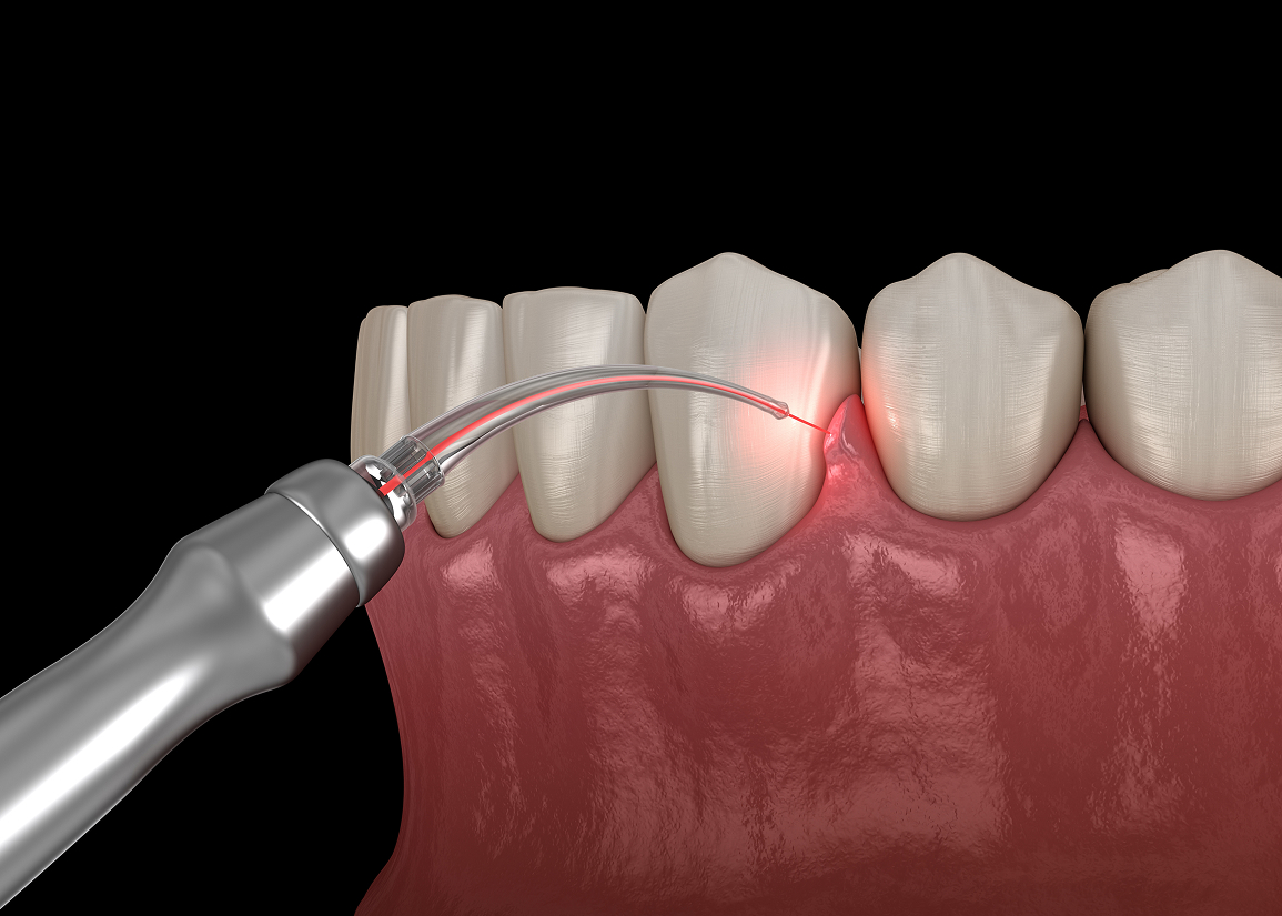 Laser dentistry for gums and teeth