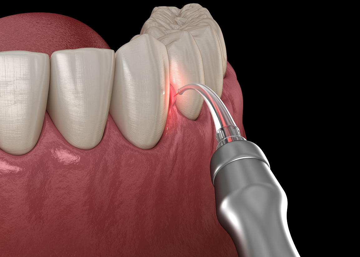 Laser dentistry for gum and soft tissue care