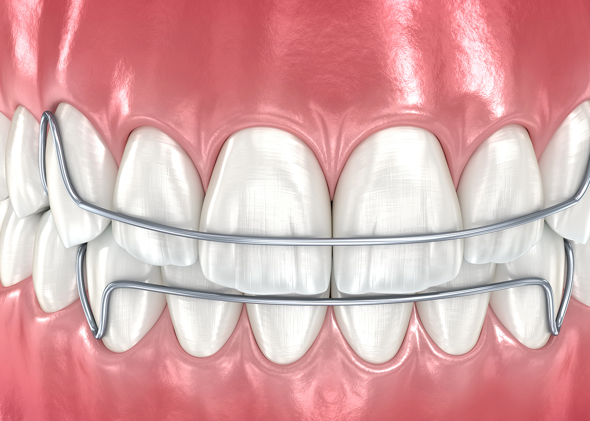 Retainer for teeth alignment