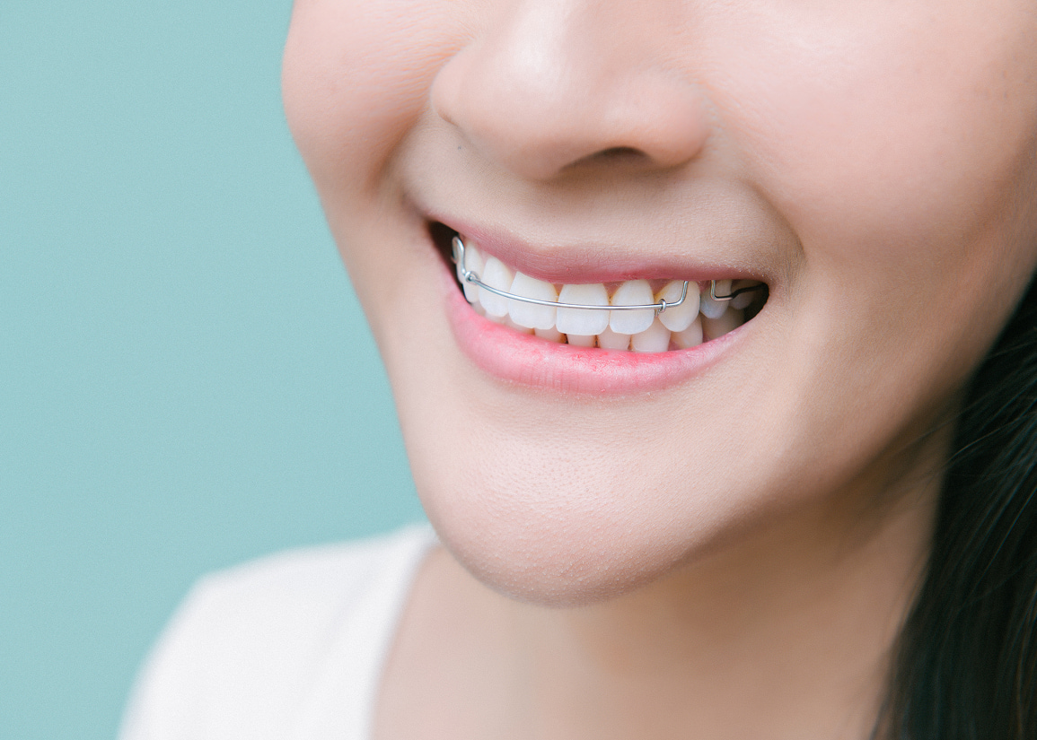 Retainer care and maintenance