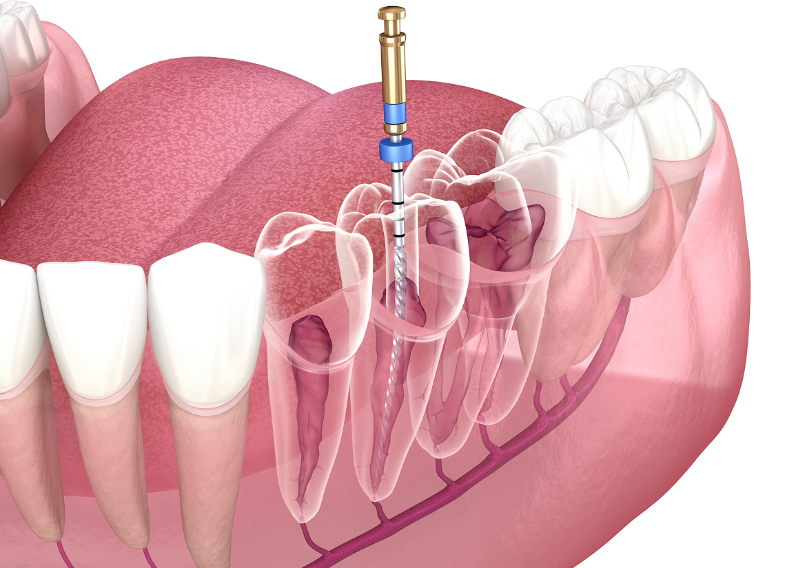 Root canal for infected or damaged tooth