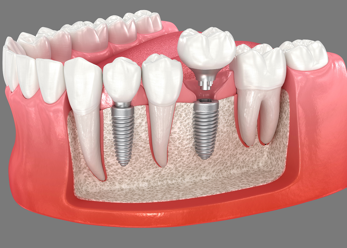 Same day dental implants overview