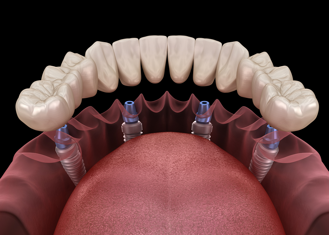 Difference between same day implants and dentures