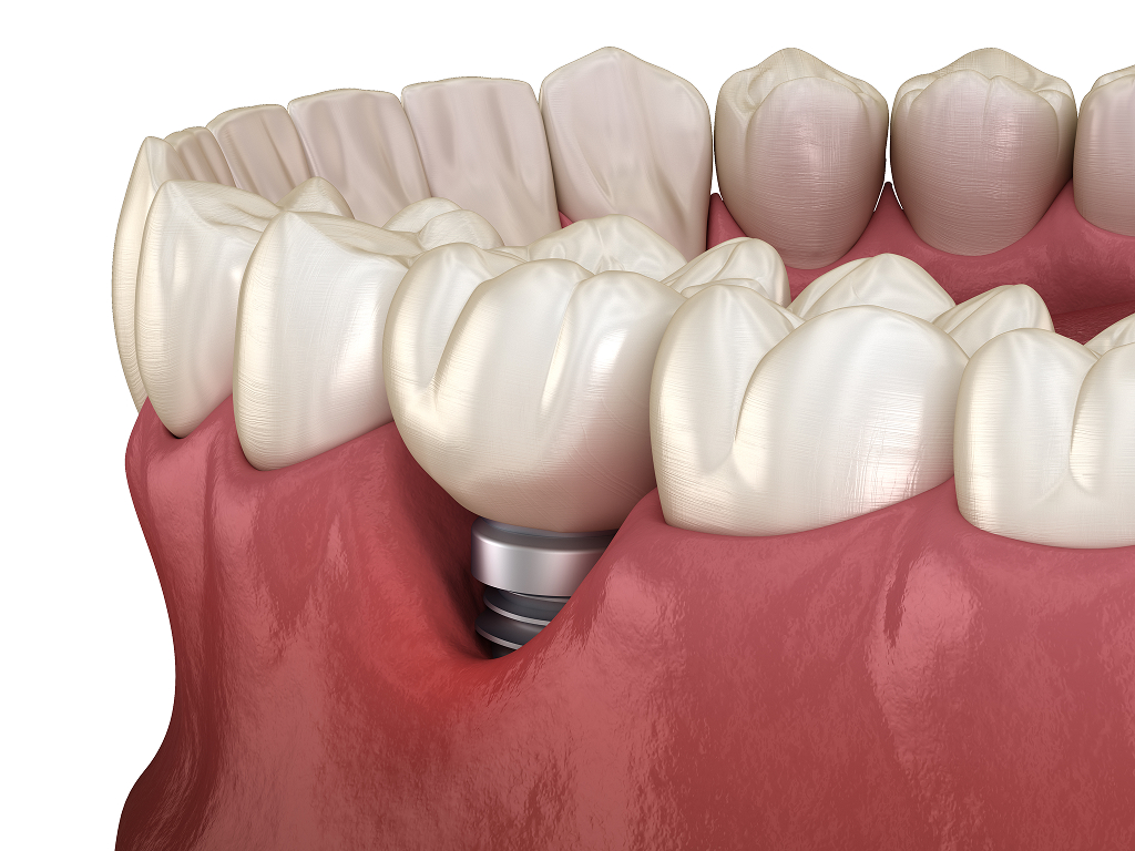 Implant Restorations