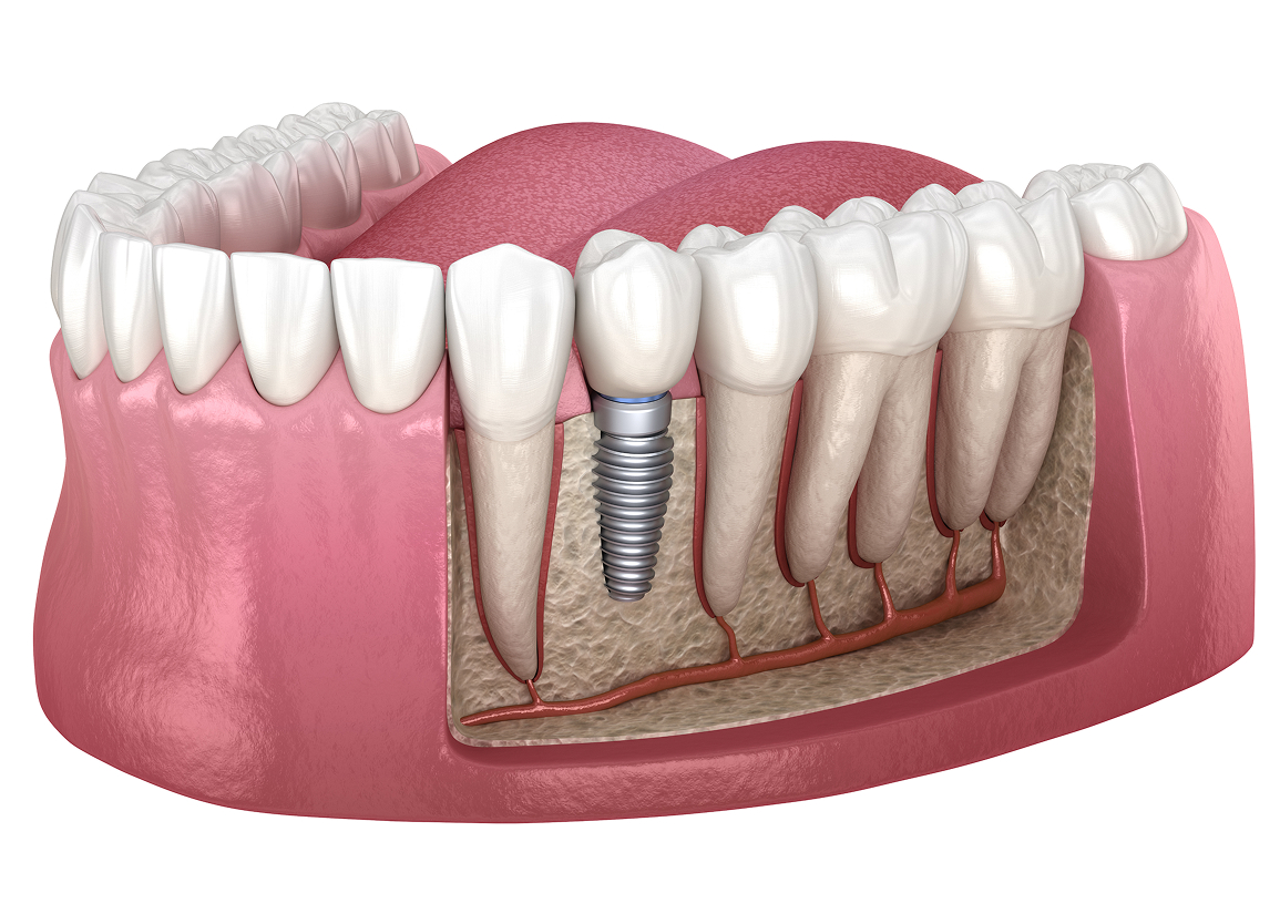 Single tooth dental implant overview