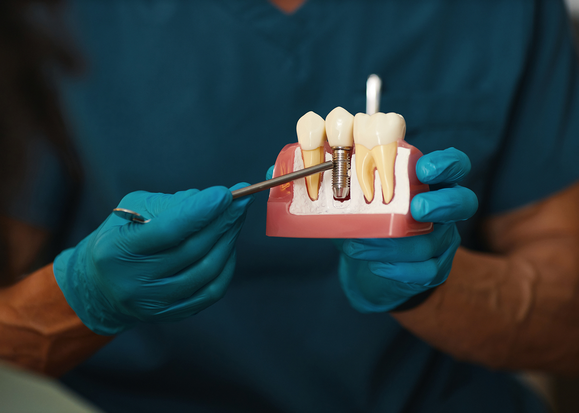 Single tooth implant eligibility