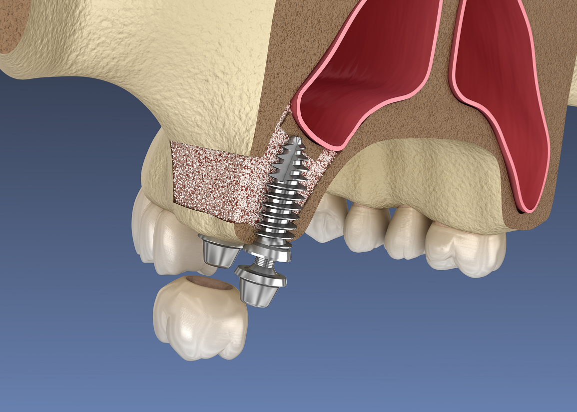 Sinus lift for dental implant preparation