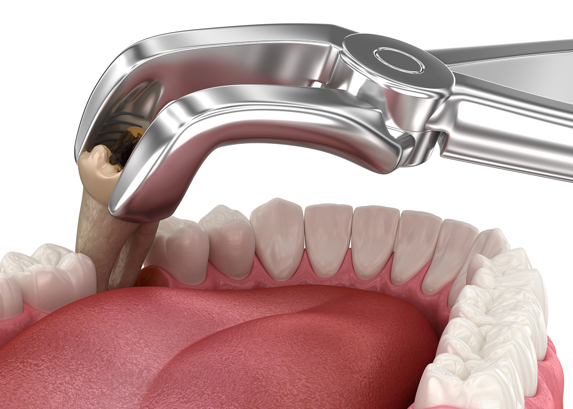 Simple or surgical tooth extraction