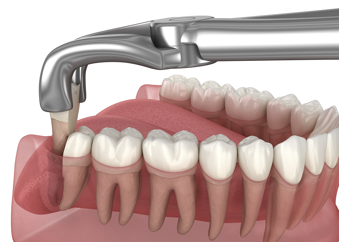 Dental implants, bridges, or dentures after extraction