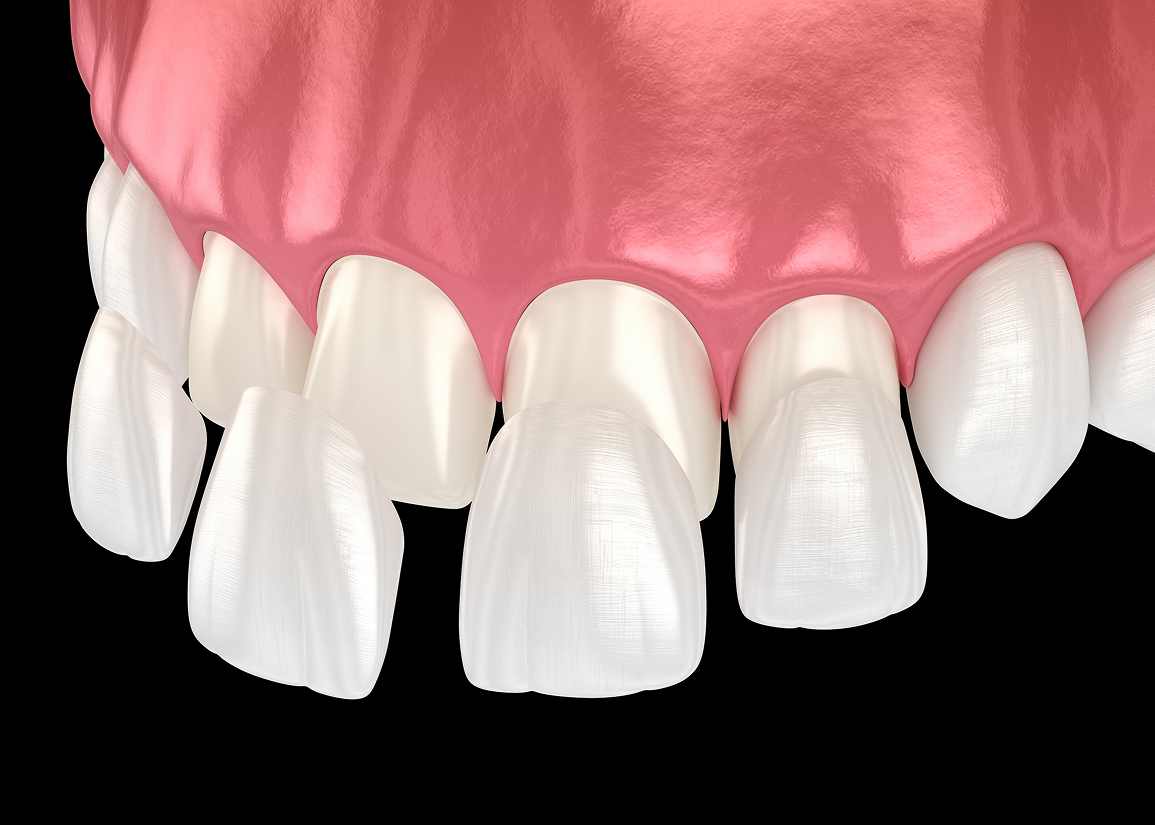 What are dental veneers