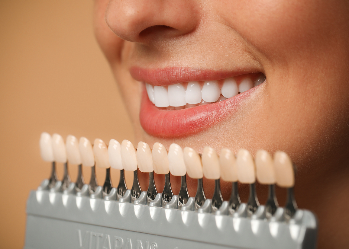 Advantages of cosmetic veneers