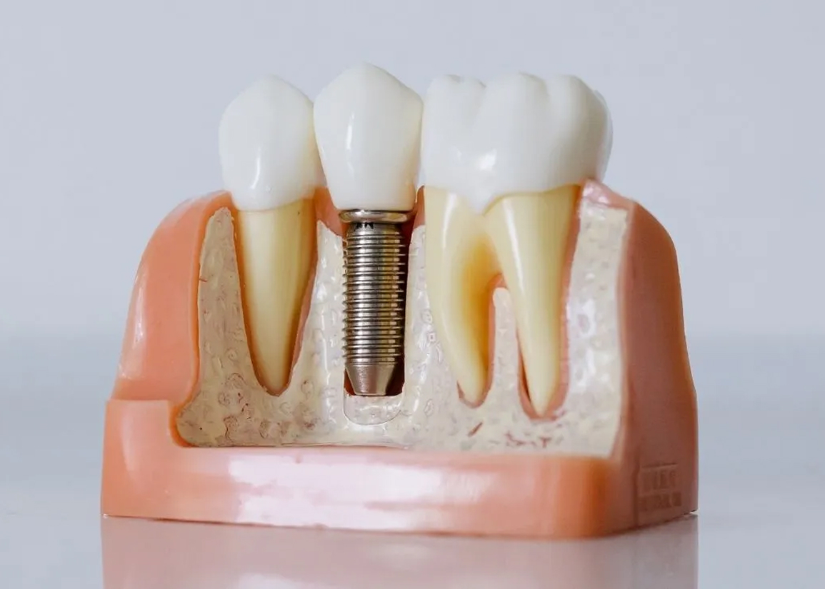 Dental Implant Services